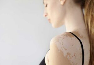 Dia Mundial do Vitiligo: doença não é transmitida entre pessoas; mitos reforçam discriminação